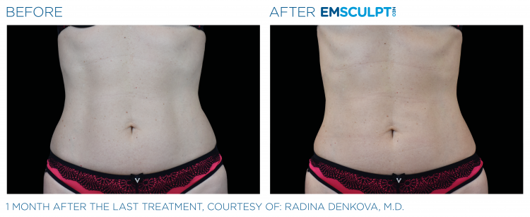 Body Contouring & Cellulite Reduction