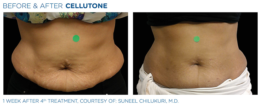 Body Contouring & Cellulite Reduction